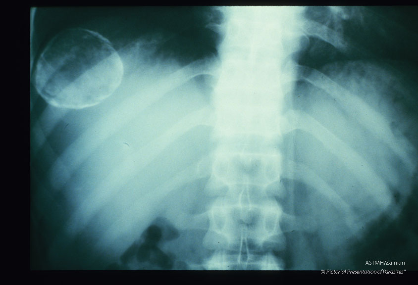 A moderately large calicifed cyst is present in the right upper lobe of the liver. It presents as a white circular line of calcium. Amorphous calcium is projected within the limiting circle. This cyst would be difficult to remove because of its position near the diaphragm.