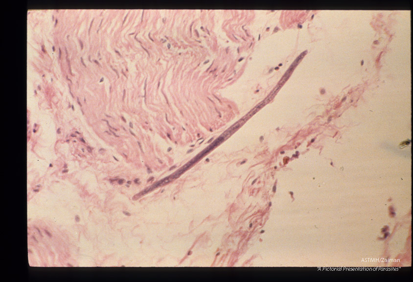Autoinfection larva pentrating deep into intestinal wall.
