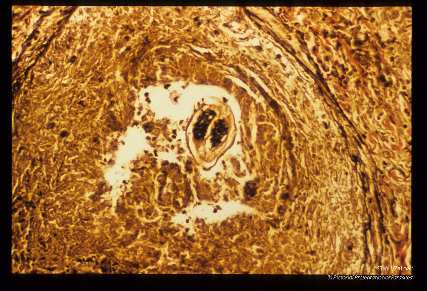 Adolescent filaria in pulmonary artery. Ipw and high power view. Elastic Berhoeff stain.