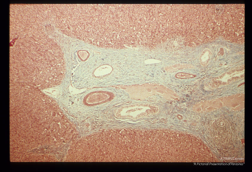 Various magnifications of advanced pipe stem fibrosis in an experimentally infected chimpanzee.