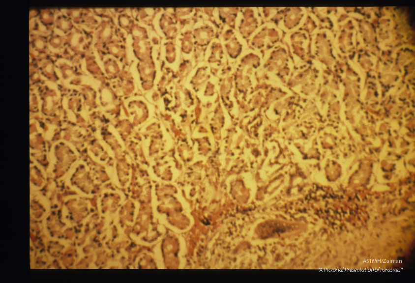 Mesocercaria in human stomach.