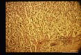 Mesocercaria in human stomach.