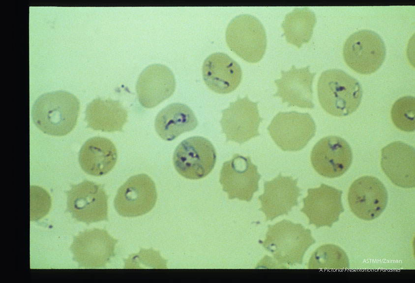 Giemsa stained slides from a fatal case on Fire Island, N. Y., (1982). The parasitemia is high for human babesiosis. Budding, multiply-infected erythrocytes, tetrad formation, band forms, reticulocytosis and clumping of extracellular parasites may be seen.