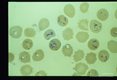 Giemsa stained slides from a fatal case on Fire Island, N. Y., (1982). The parasitemia is high for human babesiosis. Budding, multiply-infected erythrocytes, tetrad formation, band forms, reticulocytosis and clumping of extracellular parasites may be seen.