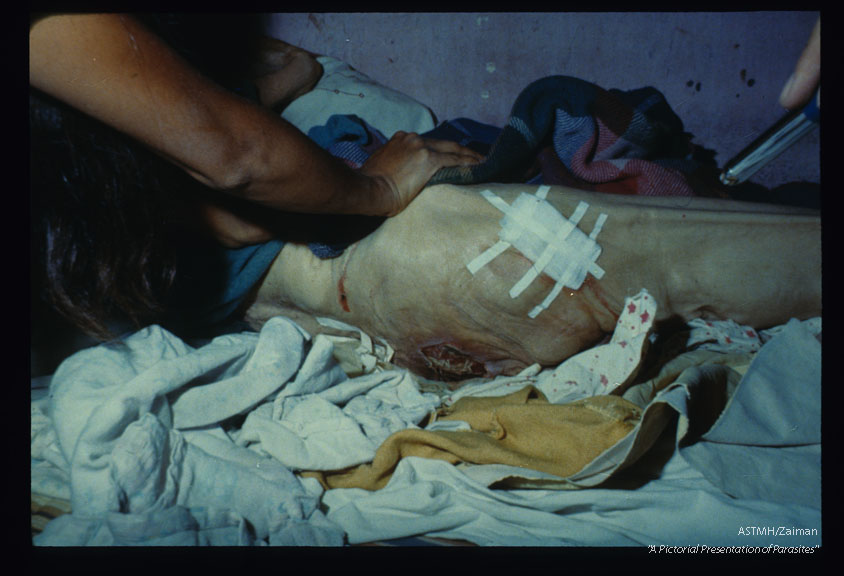 Fly larvae in a sacral decubitus ulcer. Patient confined to bed by a fractured femur. Mexico.