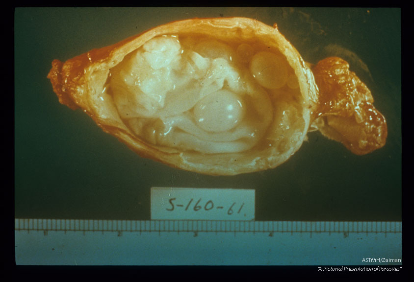 Cyst in kidney.