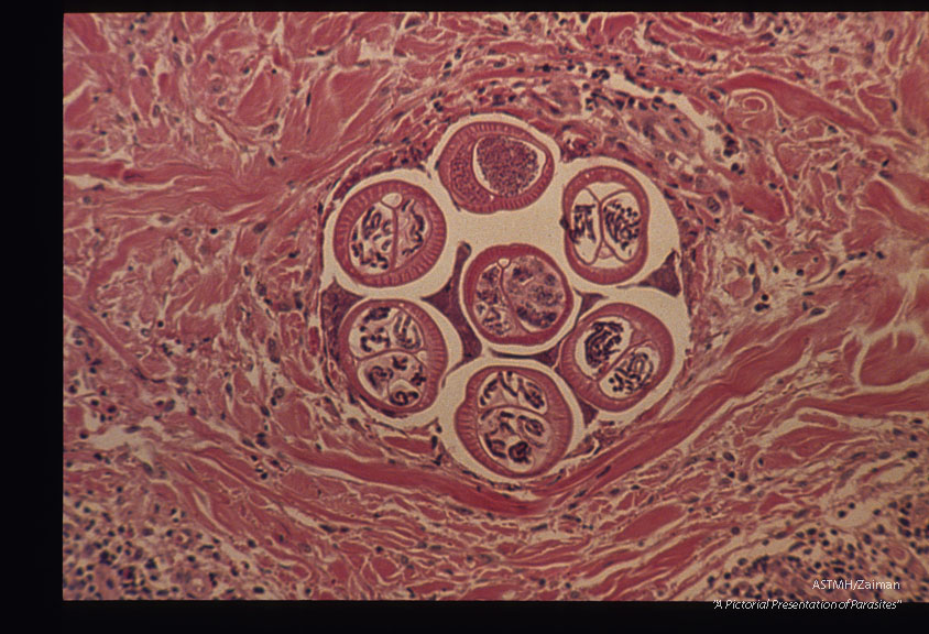 Section of skin with worms. H & E. Low and high magnifications.