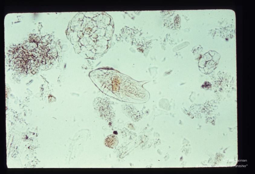 Lateral spined egg in stool.