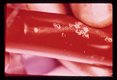 Adult schistosomes caught in blood filter.