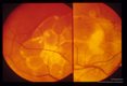 Retinal photographs showing budding cysticercus in situ.