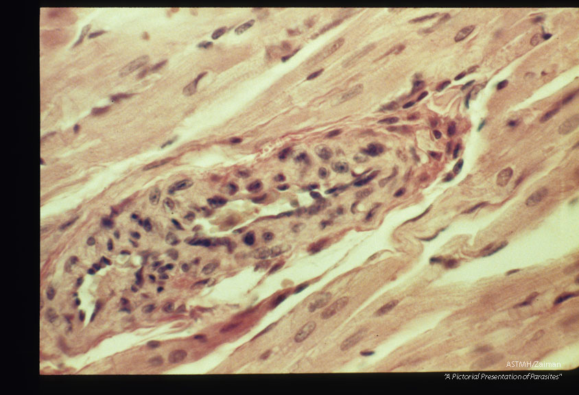 Perivascular inflammatory lesions. Experimental trichinous myocarditis in rats.