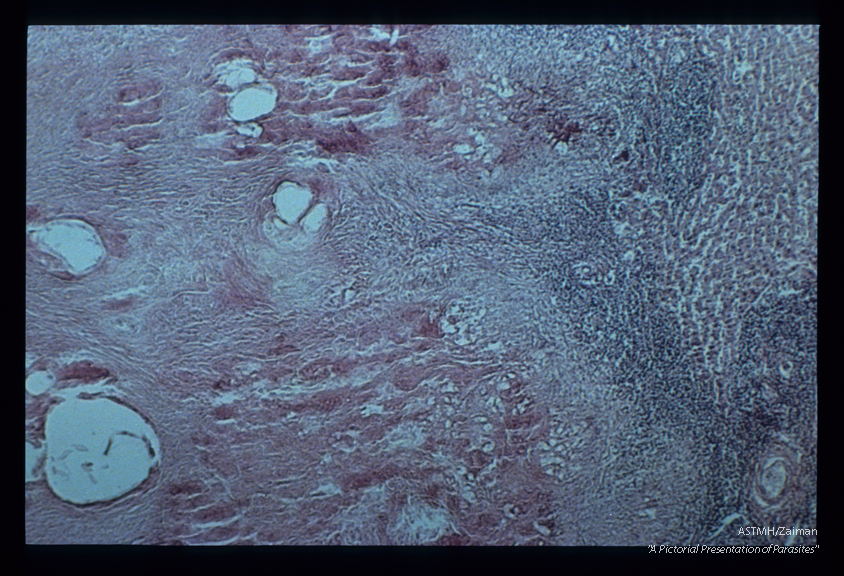 H. & E, stained section made from Eskimo liver shown on slide 165. At one side, liver and inflammatory cells are seen. The parasites appear as irregularly lined cystic spaces. Compare with slide numbers 1,2, and 3.