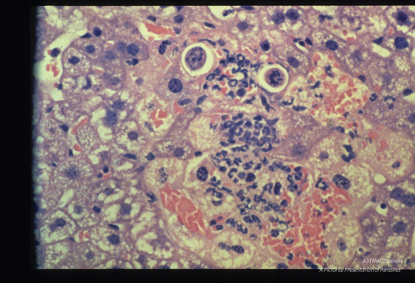 Mouse, BALB/c-Experimental infection, acute, with 5000 infective T.. canis eggs. Liver. At 48 hours PI most larvae are in the liver where they cause acute hepatocellular necrosis and neutrophil infiltration. HE, x 400.