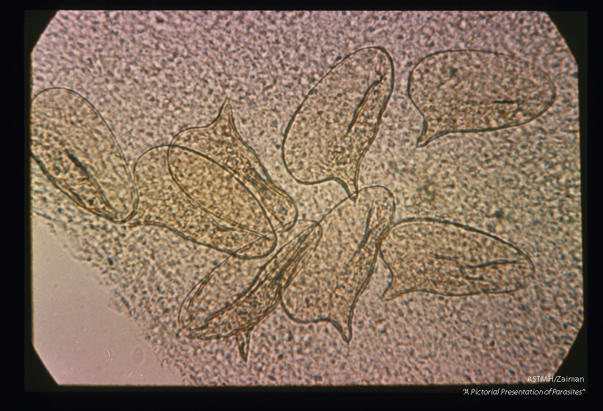 Eggs in press preparation of bowel biopsy. The lateral spines are well shown but larvae are not seen in the egg shells.