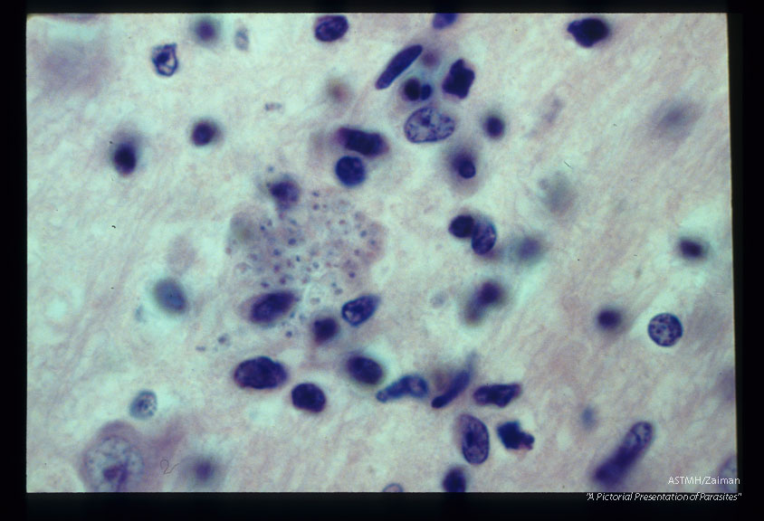 Low and high power films of child's brain showing parasites and associated inflammatory reaction.