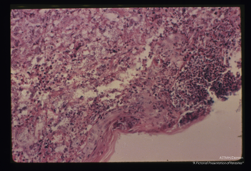 Low power view of section of ulcer. The epidermis is absent over the open ulcer. Adjacent epidermis is markedly thinned. There is destruction and inflammation below the epithelium.