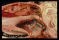 Nasal myiasis shown in sagital section through the nasal structures.