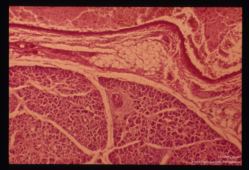 Egg in pancreas. Within the centrally placed granuloma, a collapsed egg shell can be seen.