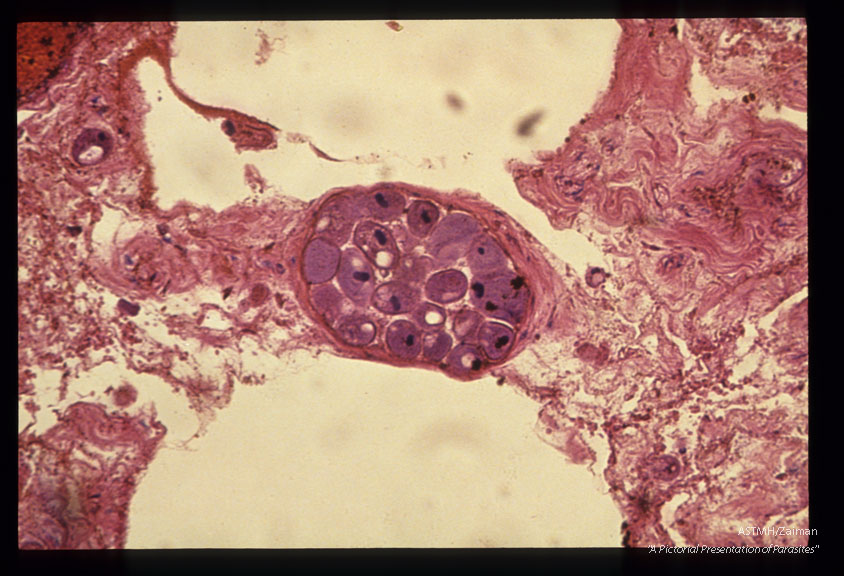 Two slides of necrotic gangrenous colon showing trophozoites in a venule. One slide is stained with H. and E. , the other with Mallory's Trichrome technique.