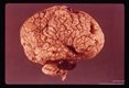 Formalin fixed hydrocephalic infant brain showing hemorrhage, congestion and pressure.