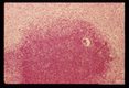 Liver with necrosis.