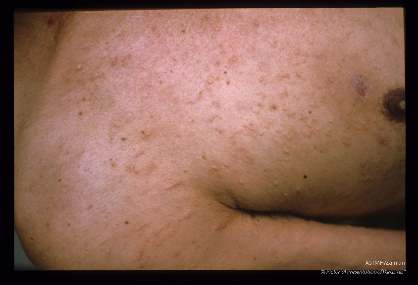 Gross pictures of male patient showing multiple skin lesions which are mostly papular and nodular. Linear elevations suggest shape of the worm beneath the skin. Note gynecomastia.