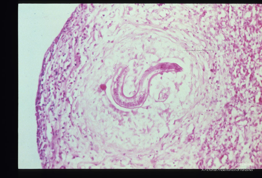 Same case. Subpleural pulmonary granuloma with larva.