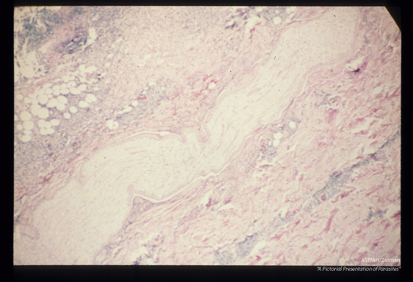 Multiple sections through subcutaneous human tissue containing a sparganum and through the sparganum itself. Note the tremendous inflammatory reaction.