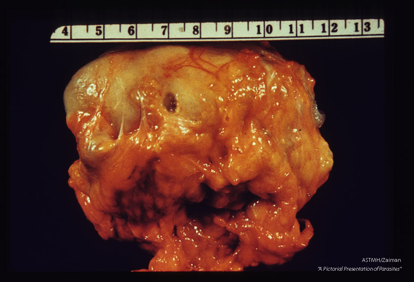 Cyst in mesentery.