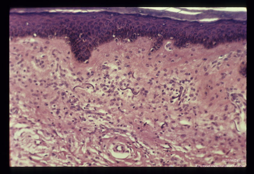 Microfilariae in subcutaneous tissue.