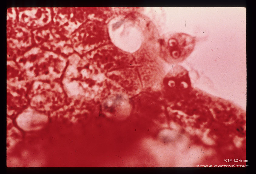 Trichrome stained peroral biopsy of duodenum showing trophozoites in close proximity to mucosa.