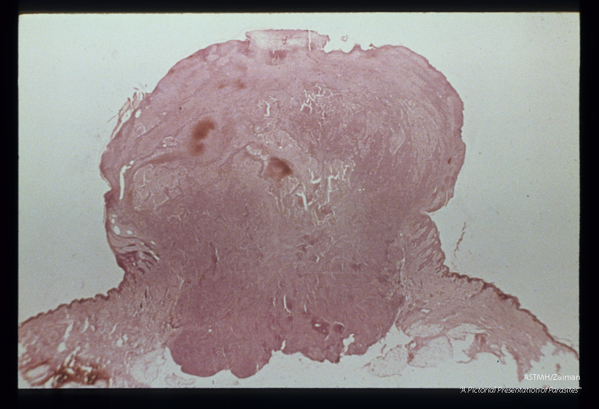 Hematoxylin-eosin stained section of gigantic facial verruca showing angiomatous character.