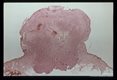 Hematoxylin-eosin stained section of gigantic facial verruca showing angiomatous character.