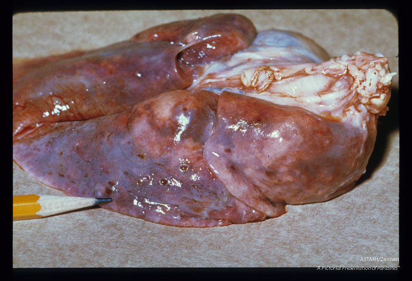 Perforation of the lung (at the pencil tip) several days after worms reach the pleural cavity.