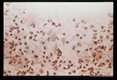 Inflammatory exudate associated with infection.