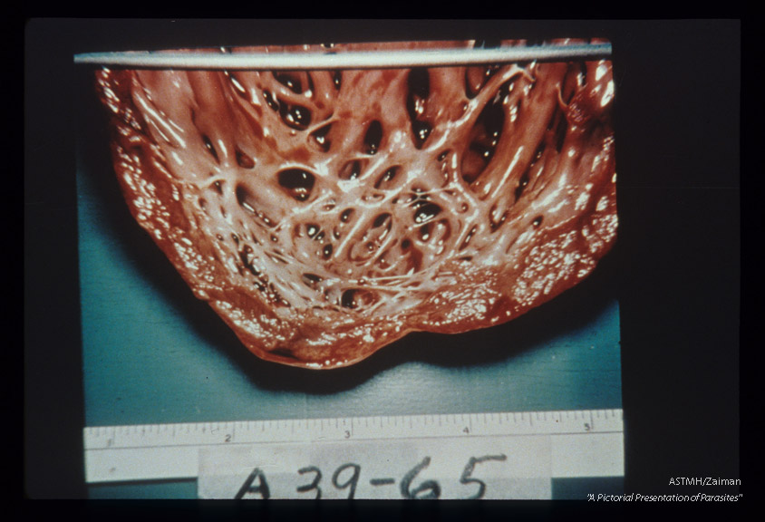 Gross pathology. Opened heart showing myocarditis in Chagas' disease.