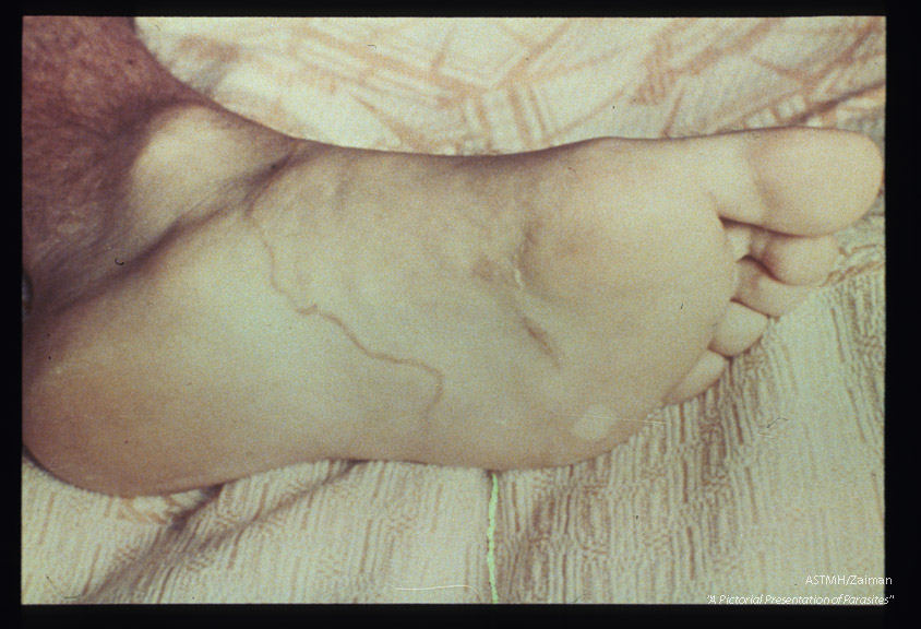 Plantar surface of foot.