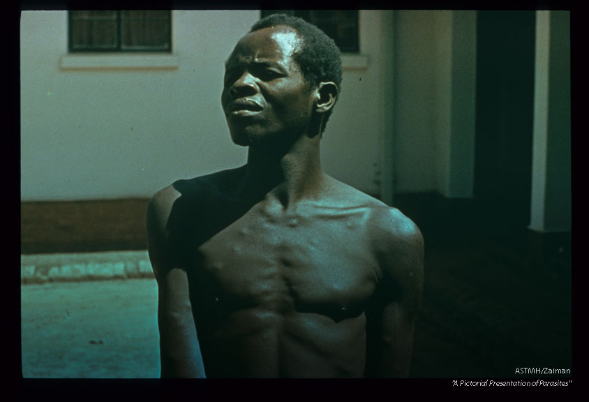 An adult african male showing numerous subcutaneous swellings which proved to the larval parasites, Cysticercus cellulosae.