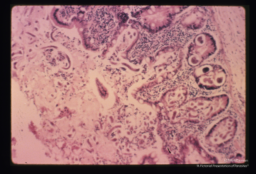 Human bowel. There is a copious outpouring of mucus into the bowel lumen. In the mucus, one can see longitudinal and cross sections of larvae. Eggs and larvae arc present in the crypts.