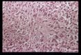 (South America). Hematoxylin-eosin stained tissue section showing tuberculoid (granulomatous) reaction with central necrosis but no parasites.
