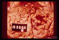 Lee case of primary amoebic meningoencephalitis. Whole brain.