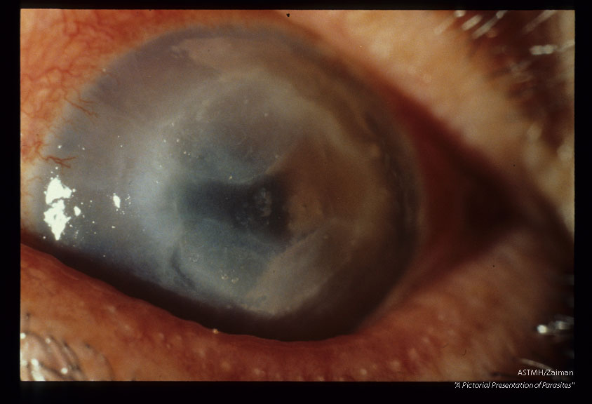 Progressive keratitis in 59 year old male rancher. Slide dated 2-16-73.