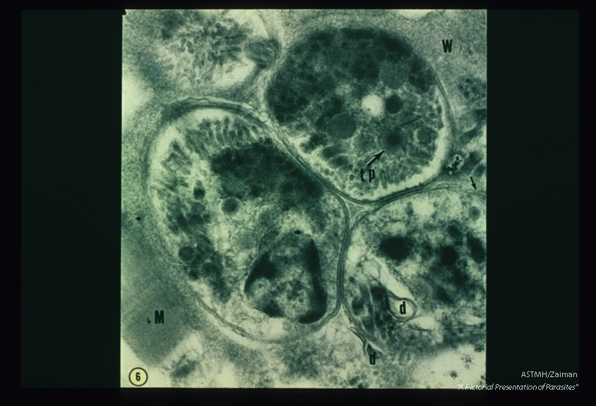 Ultrastructure of parasite in human heart muscle. The nucleus and pellicle are well demonstrated in this photograph. d-dumb-bell shaped bodies seen in and outside parasites, m-cardiac myofibre, tp-Convoluted tube with increased density in central core