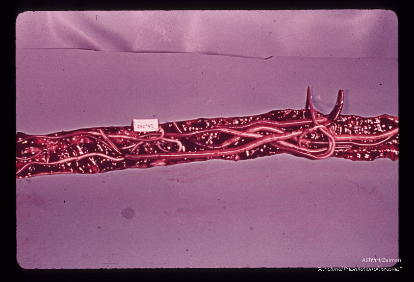 Trichuris tichiura, Balantidium coli,Entamoeba histolytica. Autopsy specimen showing adult helminths, ulcerations and bloody intestinal contents.