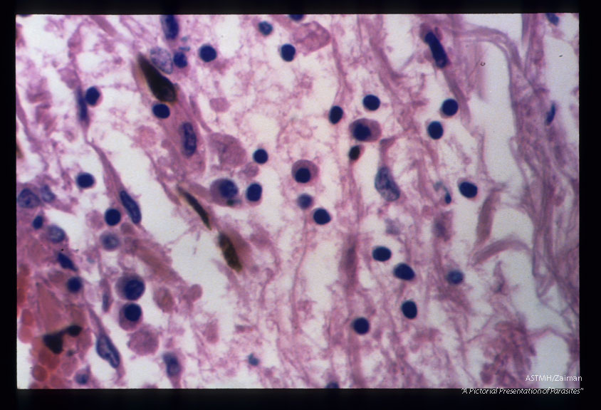 Chronically inflamed meninges.