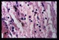 Chronically inflamed meninges.