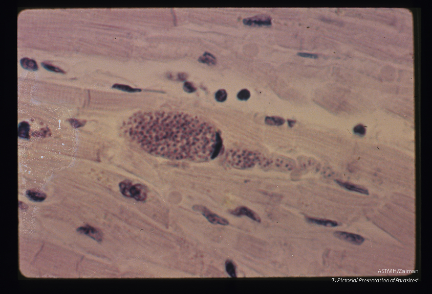 High power view of pseudocyst with the tadpole shape.