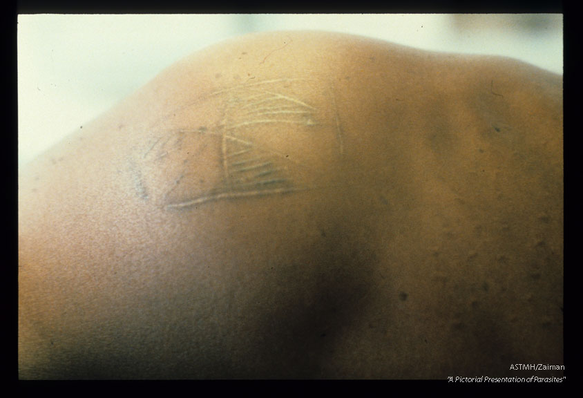 Scarification by native practitioners over an amoebic liver abscess.