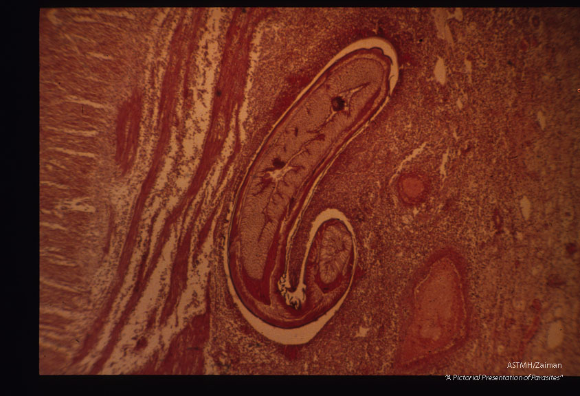 Low and high power magnifications of worm in human stomach wall. Case from Holland.