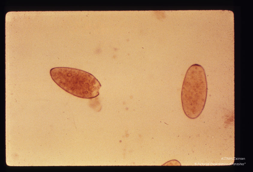 Egg in stool; note that the operculum on one has separated from the remainder of the egg shell.